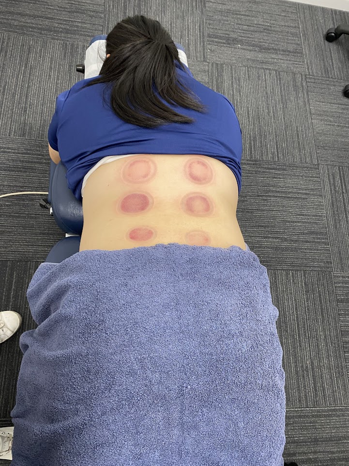 Cupping marks