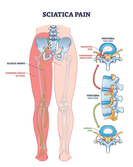 Picture of the areas of sciatica pain